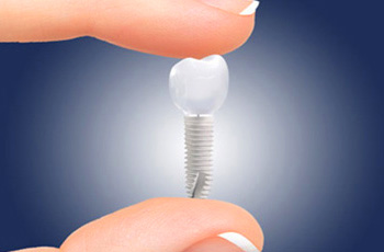 Implantat-Beratung